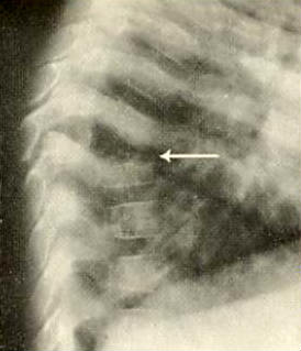 salmonella typhi diagnostic infection of upper thoracic spine