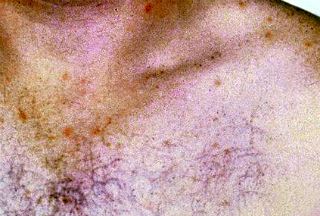 salmonella typhi symptoms image